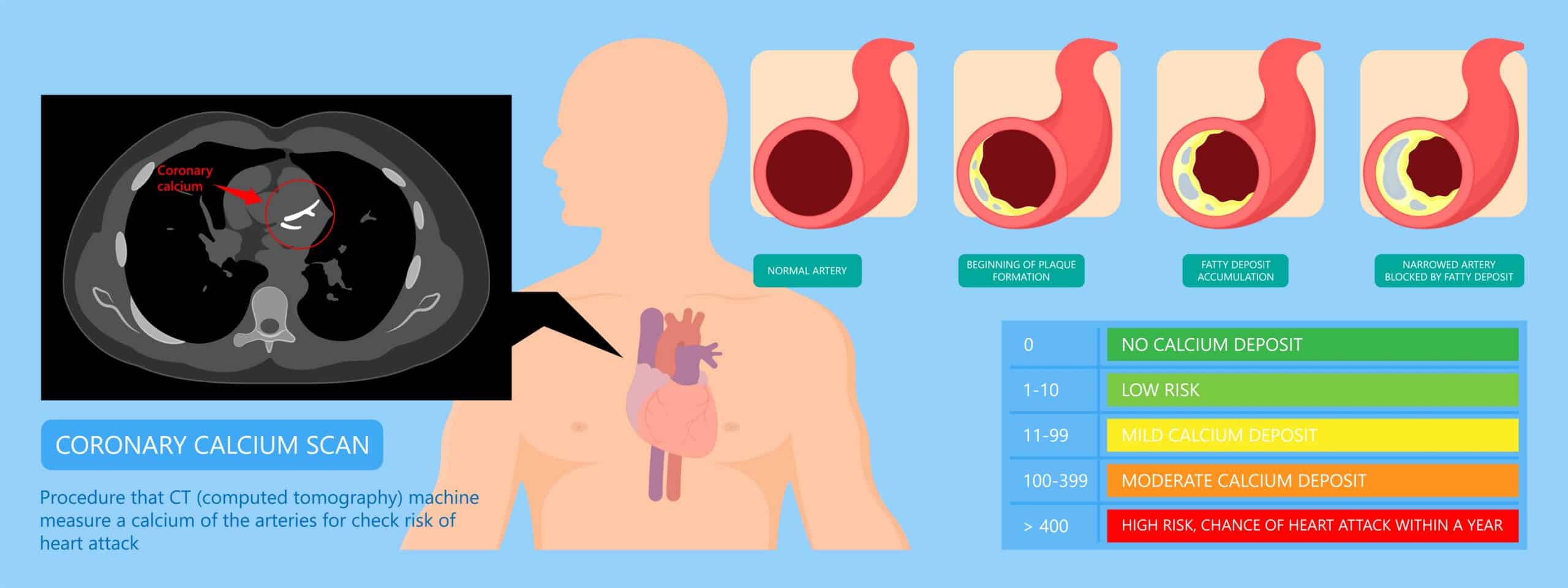 Calcium Score Screening